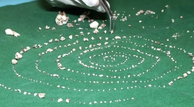 7 yaşındaki çocuğun ağzından 526 diş çıkarıldı