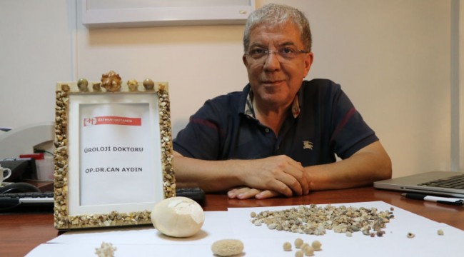 Hastalarından çıkardığı böbrek taşlarını koleksiyon yaptı