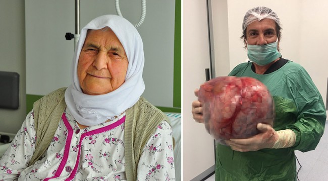 Kilo aldığını sandı, karnından 12 kiloluk kist çıktı