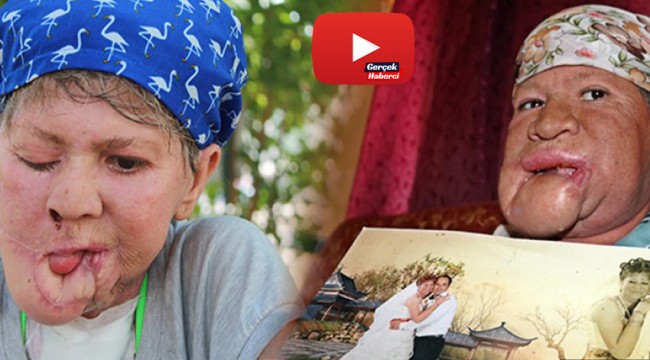 Çenesinde çıkan sivilce hayatını kararttı, kızının derdine düştü