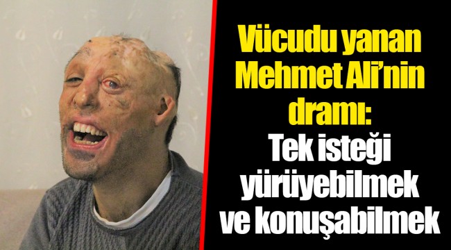 Vücudu yanan Mehmet Ali’nin dramı: Tek isteği yürüyebilmek ve konuşabilmek