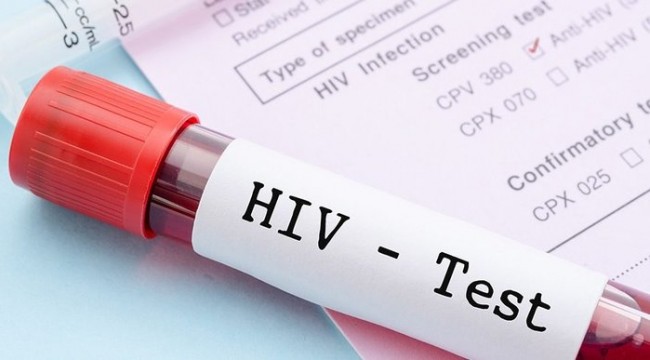 HIV testi 4-6 haftada sonuç veriyor