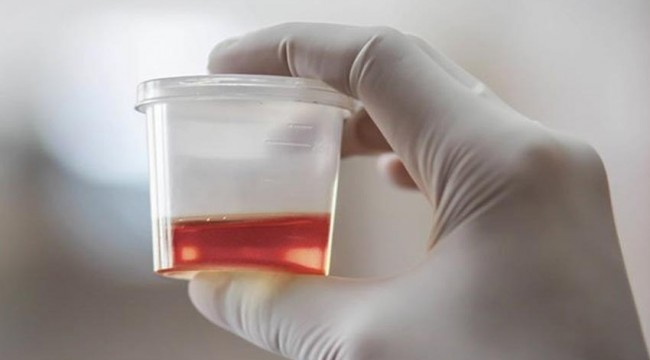 İdrarda kan görülmesi birçok hastalığın habercisi olabilir