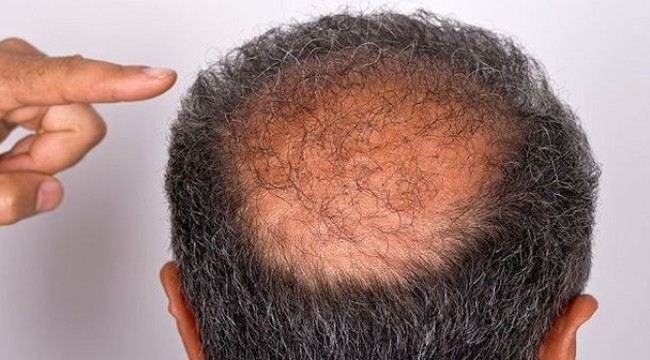 Saç dökülmesi erkekleri daha yaşlı gösteriyor