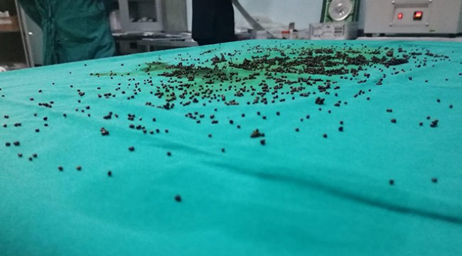 Safra kesesinden 3 bin 765 taş çıkarıldı