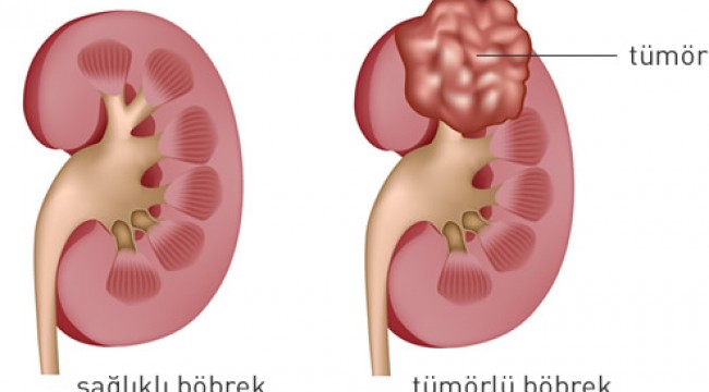 “Böbrek tümörleri en sık 50-60 yaşlarında oluşur”