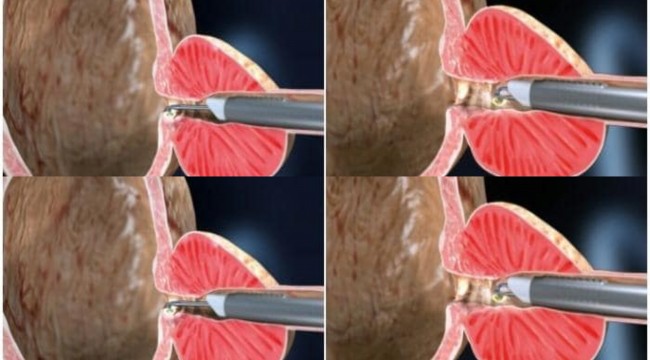 Prostat tedavisinde “plazma kinetik TUR yöntemi” ile başarılı sonuçlar alınıyor