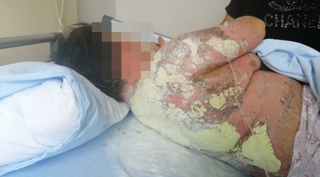 Genç kadın antibiyotik yüzünden tanınmaz hale geldi