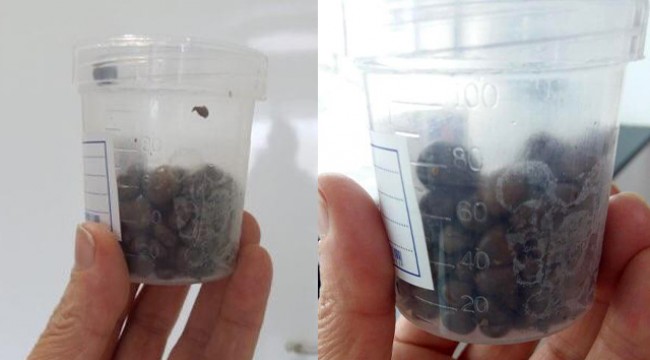 Ameliyat olan hastanın böbreğinden 120 adet taş çıktı
