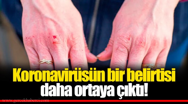 Koronavirüsün bir belirtisi daha ortaya çıktı!