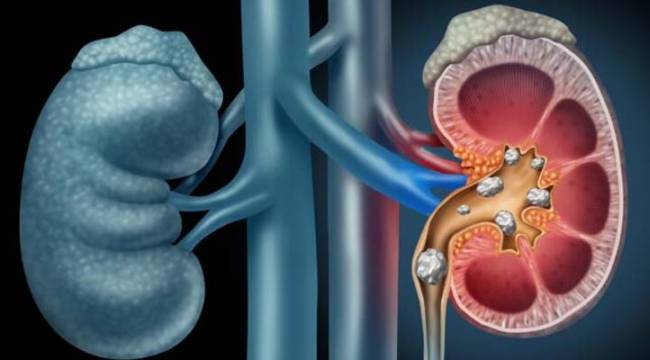 Yaz aylarında sıklığı artan hastalık: Böbrek taşı
