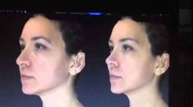 Yüz şekillendirmede en çok tercih edilen estetik Venüs Face