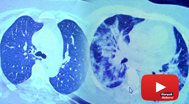 İlaç kullanan korona hastaları ile kullanmayanlar arasındaki inanılmaz fark