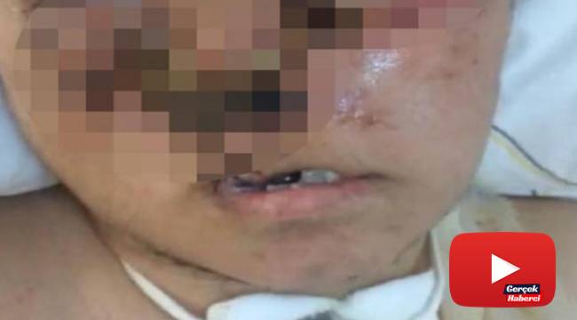 Eniştesinin saldırısı sonucu ağır yaralandı, yüzü tanınmayacak hale geldi