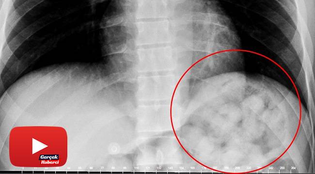 Karnından uyuşturucu zulası çıktı