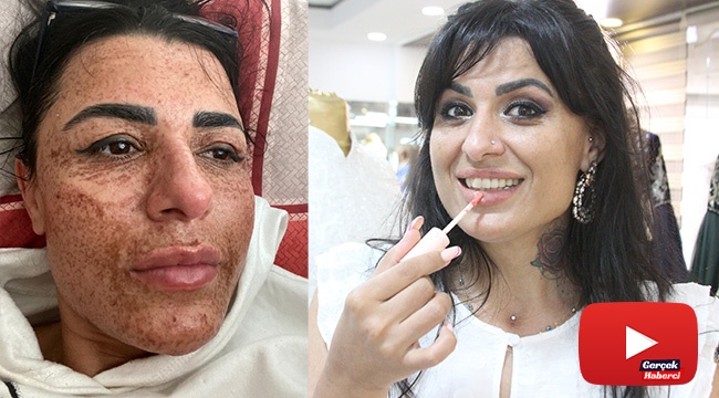 Sosyal medyada gördüğü ilanla cilt bakımı yaptırdı, eski yüzüne 8 ayda kavuşabildi