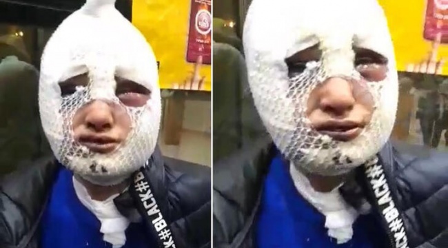 Eski kız arkadaşının yüzüne kızgın yağ döken zanlı 2.5 ay sonra tahliye oldu
