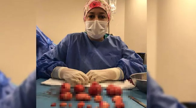 Bursa'da hastanın rahminden 21 miyom çıkarıldı