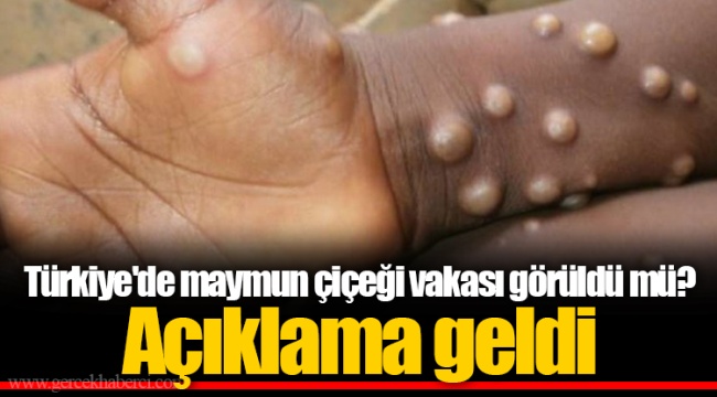 Türkiye'de maymun çiçeği vakası görüldü mü? Açıklama geldi