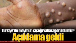 Türkiye'de maymun çiçeği vakası görüldü mü? Açıklama geldi