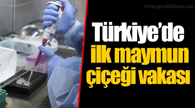 Türkiye'de ilk maymun çiçeği vakası