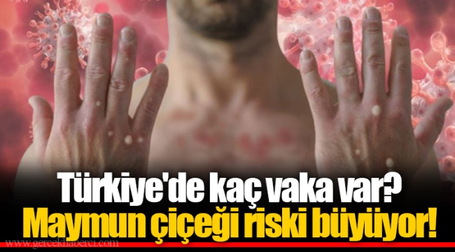 Türkiye'de kaç vaka var?   Maymun çiçeği riski büyüyor!