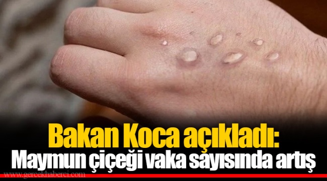 Bakan Koca açıkladı: Maymun çiçeği vaka sayısında artış