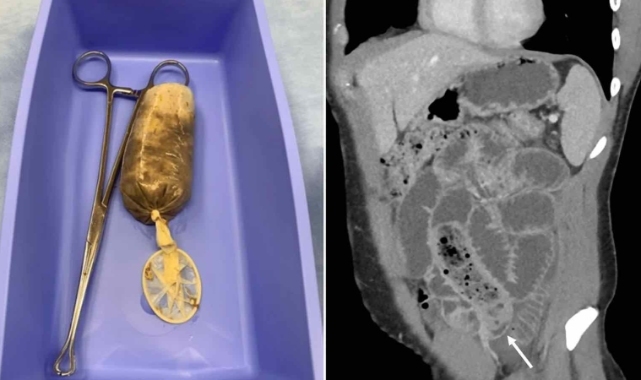 Acile başvuran adamın midesinden prezervatife doldurulmuş muz çıktı