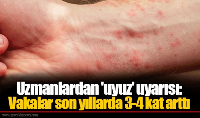 Uzmanlardan 'uyuz' uyarısı: Vakalar son yıllarda 3-4 kat arttı