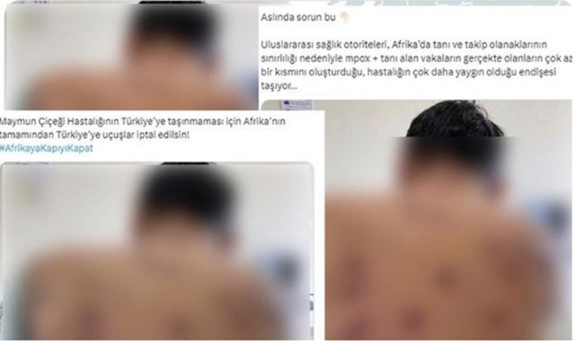 Cumhurbaşkanlığından 'maymun çiçeği' açıklaması