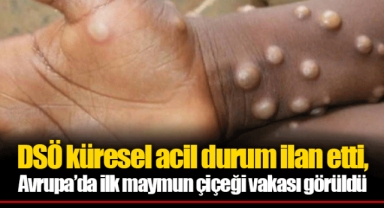 DSÖ küresel acil durum ilan etti, Avrupa’da ilk maymun çiçeği vakası görüldü