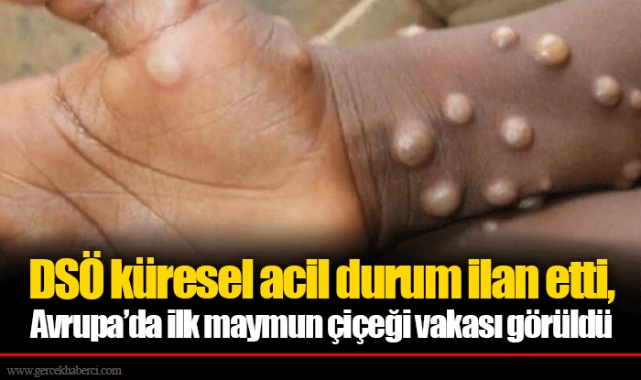 DSÖ küresel acil durum ilan etti, Avrupa’da ilk maymun çiçeği vakası görüldü