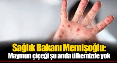 Sağlık Bakanı Memişoğlu: Maymun çiçeği şu anda ülkemizde yok
