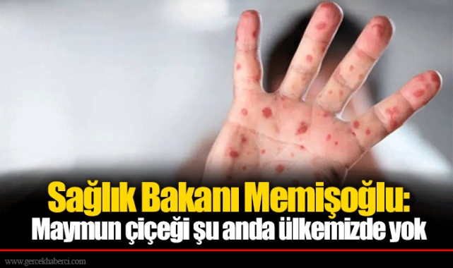 Sağlık Bakanı Memişoğlu: Maymun çiçeği şu anda ülkemizde yok