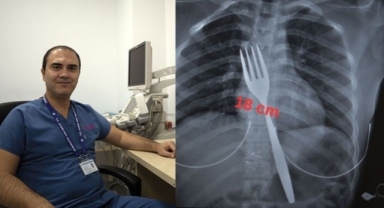 Aydın'da genç kız 18 cm'lik çatalı yuttu: Bilimsel makaleye konu olacak
