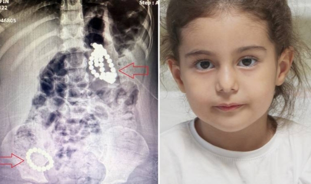 Doktorları bile şoke eden vaka: 3 yaşındaki çocuğun karnında 66 adet mıknatıs çıkarıldı!