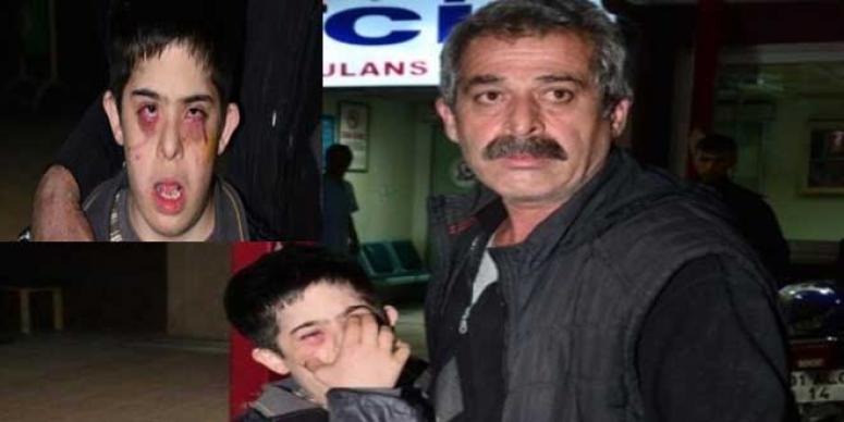 DOWN SENDROMLU ÇOCUK EVE GÖZLERİ MOSMOR DÖNDÜ