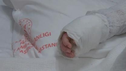20 aylık bebeğin üzerine kaynar su döküldü! Vücudunun yüzde 27’si yandı